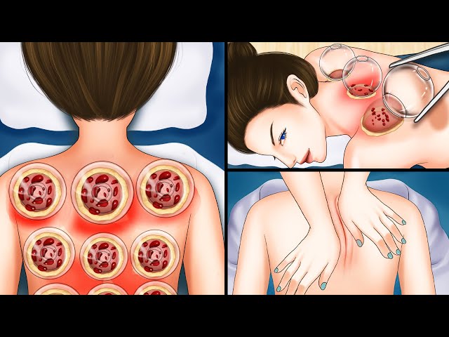 ASMR Fire cupping therapy and back massage on girl for pain relief | Hijama treatment animation