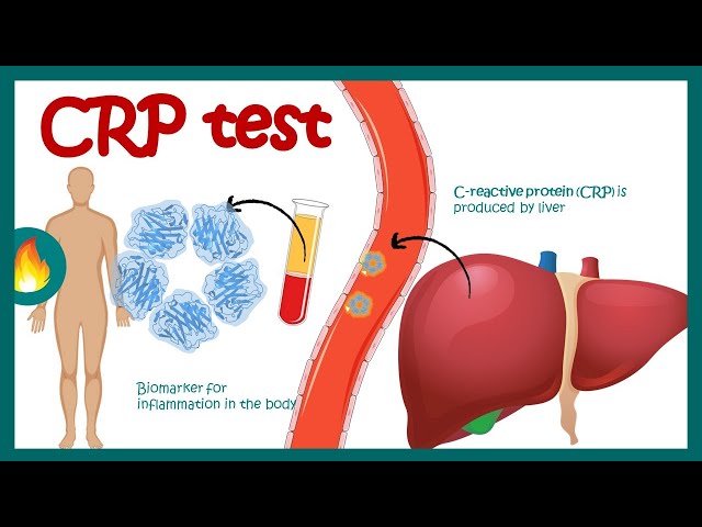 C-Reactive Protein (CRP) | Inflammation | Acute phase reactant | How do you read CRP test results?