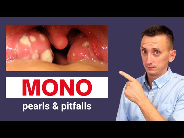 Infectious Mononucleosis (Mono) Symptoms, Diagnosis, and Treatment