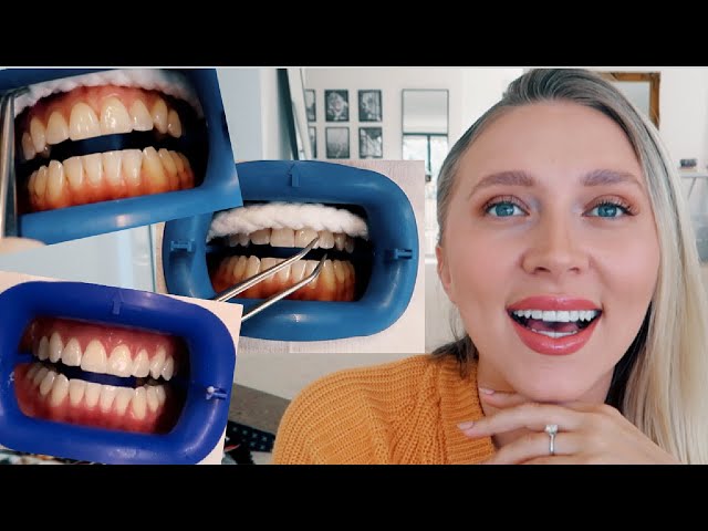 IS IT WORTH IT? Professional teeth whitening! BEFORE & AFTER!