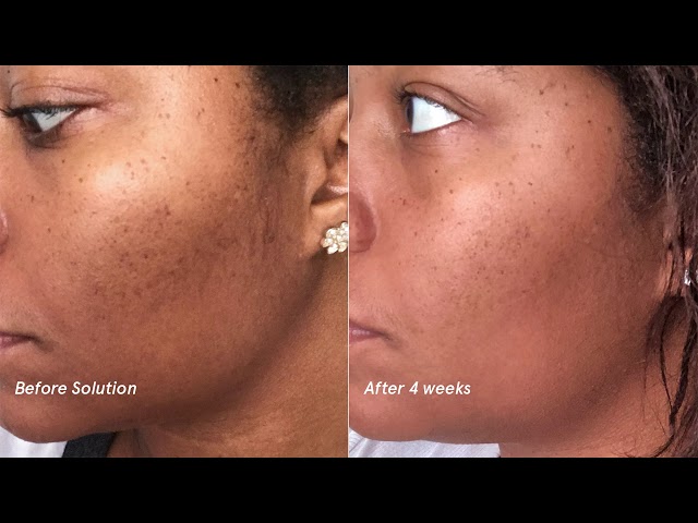 Glossier Solution: Aziza, Before and After
