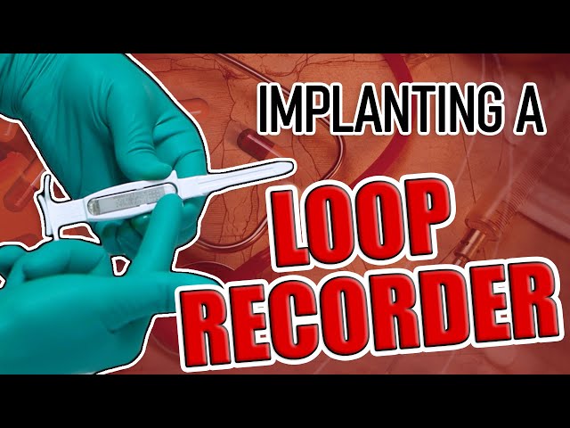 Loop Recorder Implant Procedure
