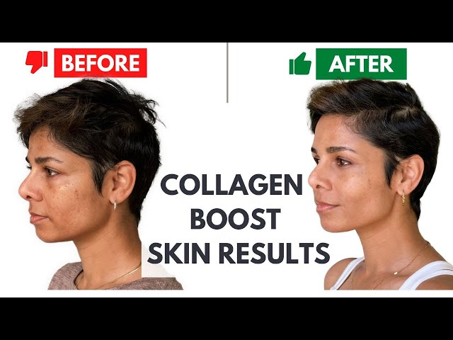 6 Non invasive ways to boost collagen in your skin