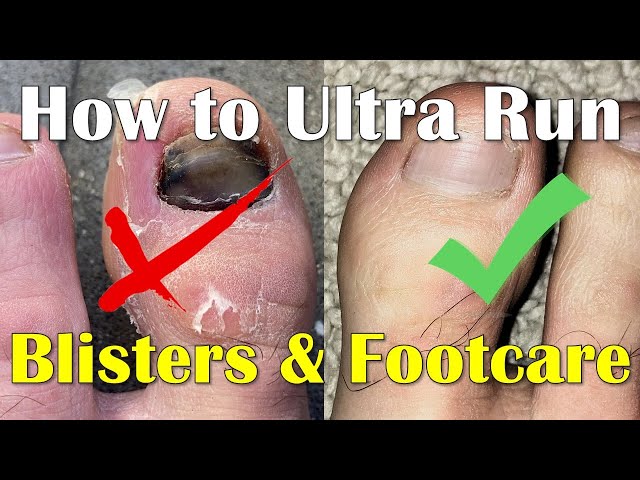 Blisters Prevention and Footcare for runners - How to Run an Ultra Marathon