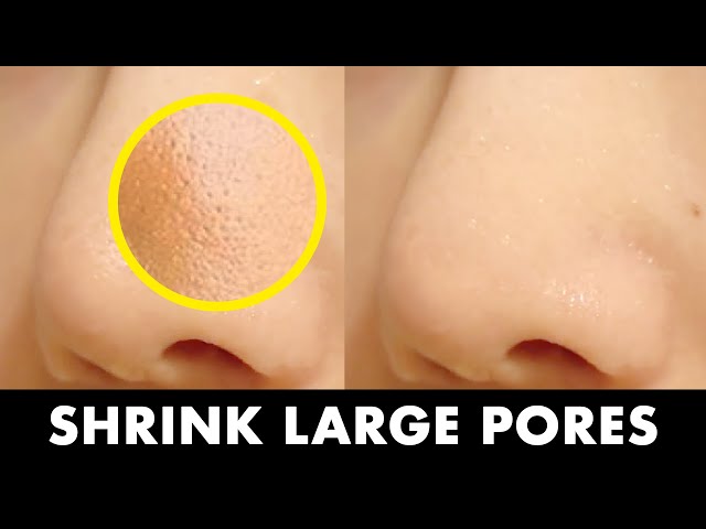 5STEP Dermatologist's Tip to Shrink Large Pores! How to Tighten & Unclog Pores
