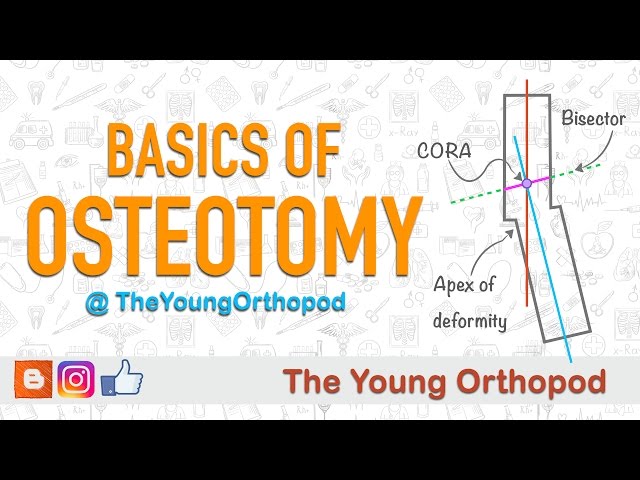 Basics of Osteotomy