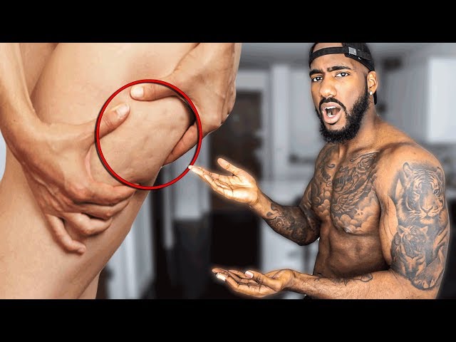 IF YOU HAVE CELLULITE..(WATCH THIS!)