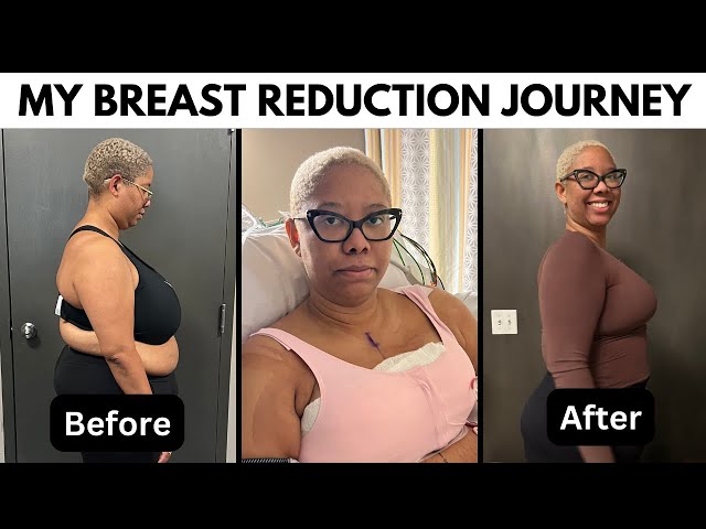 My Breast Reduction Surgery and Recovery Vlog - Answering All Of Your Questions!