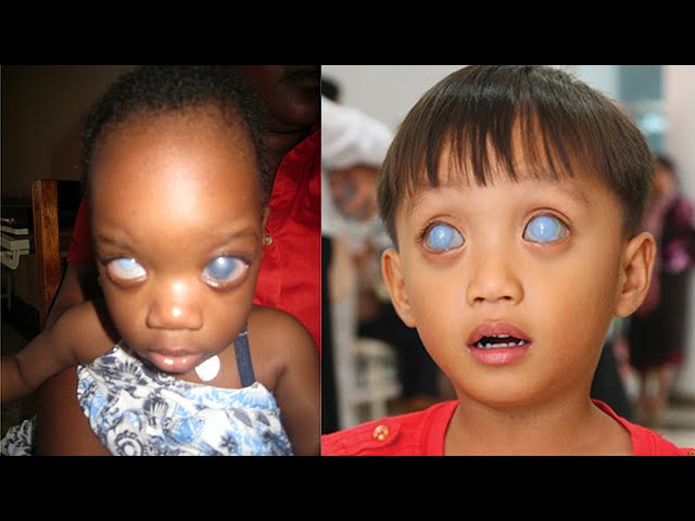 5 Extremely Rare Kids From Around The World