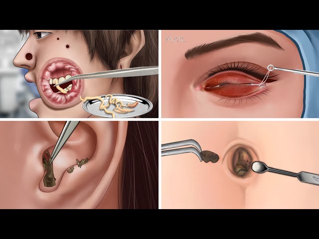 ASMR Cleaning big hole swollen face piercings | Removal animation|Ear cleaning