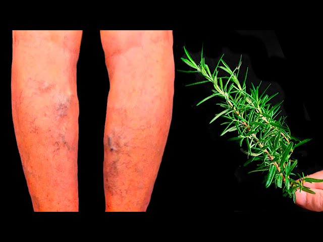 Unbelievable! Varicose veins disappear! A treasure that everyone should have in their home