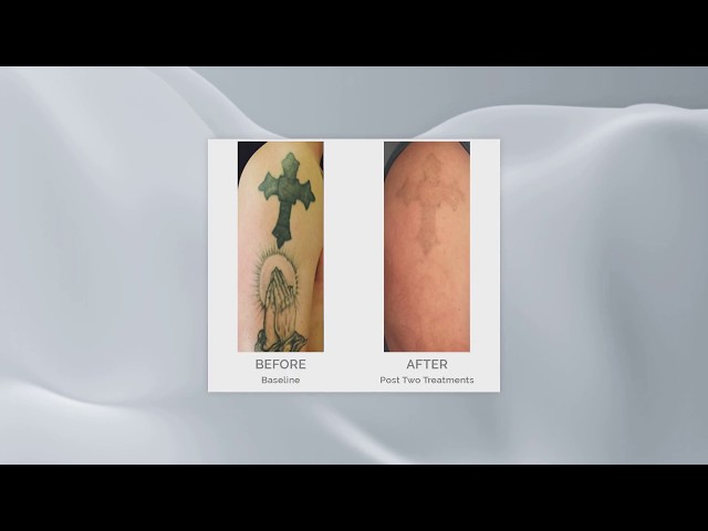 Enlighten Tattoo Removal | Before & After