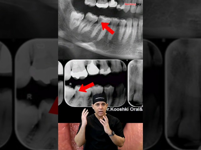 ببینید پوسیدگی با دندان چیکار میکنه! چکاپ های منظم دندانپزشکی را جدی بگیرید.