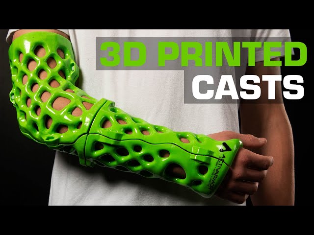 Custom 3D Printed Casts | Real 3D Printed Products | ActivArmor