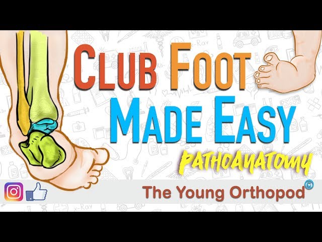 CLUB FOOT Pathoanatomy Made Easy - The Young Orthopod