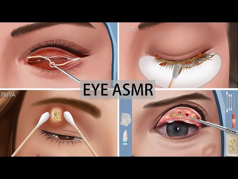 Eye ASMR| eye stone removal| lashes cleaning|eye mucous removal animation