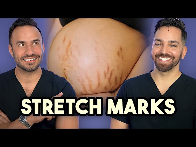 Major Announcement + How to Treat Stretch Marks like a Dermatologist