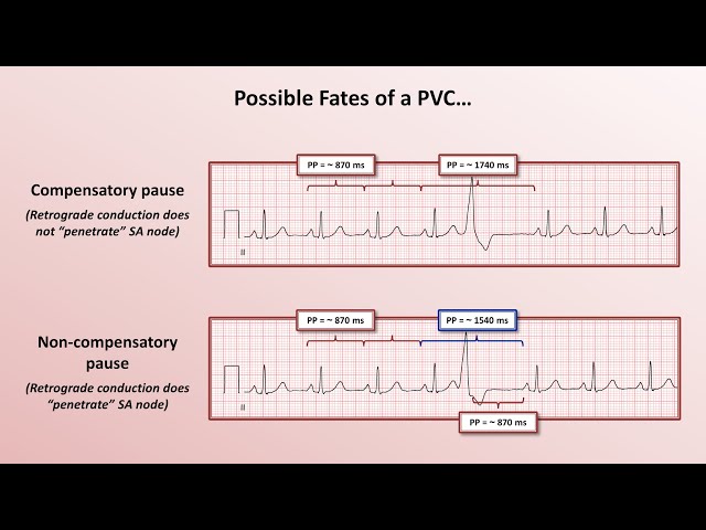Advanced EKGs - PACs and PVCs (i.e. premature beats)