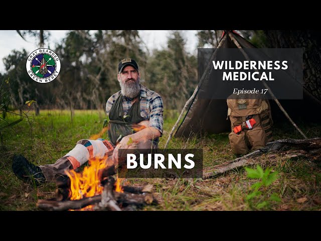 Burns | Wilderness Medical S1E17 | Gray Bearded Green Beret