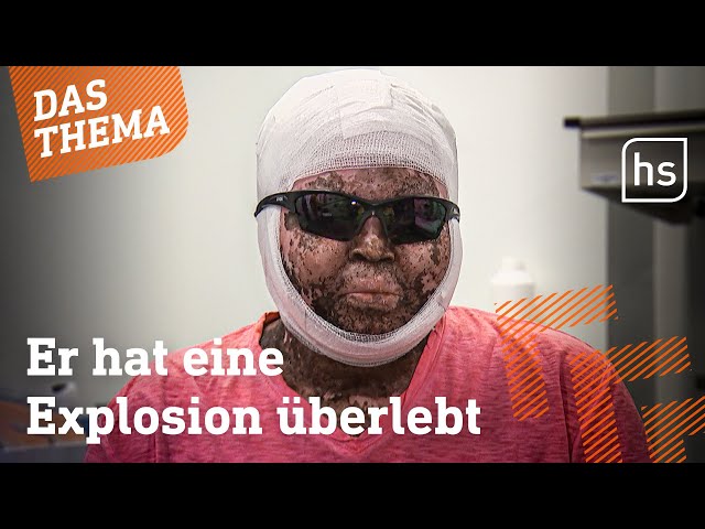 Ärzte in Hessen retten Brandopfer das Leben | hessenschau DAS THEMA