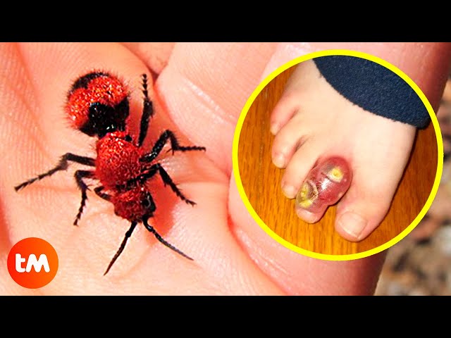 The WORST INSECT BITES In The World 😫🐝