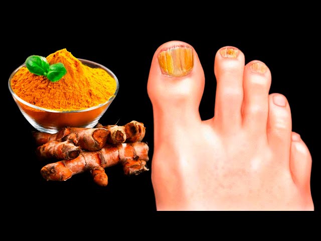 Kills nail fungus instantly! Best remedies! Benefits of Turmeric
