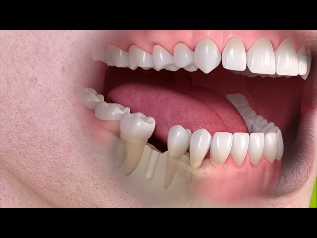Dr. Jaron Theis explains what  Dental Implants are!