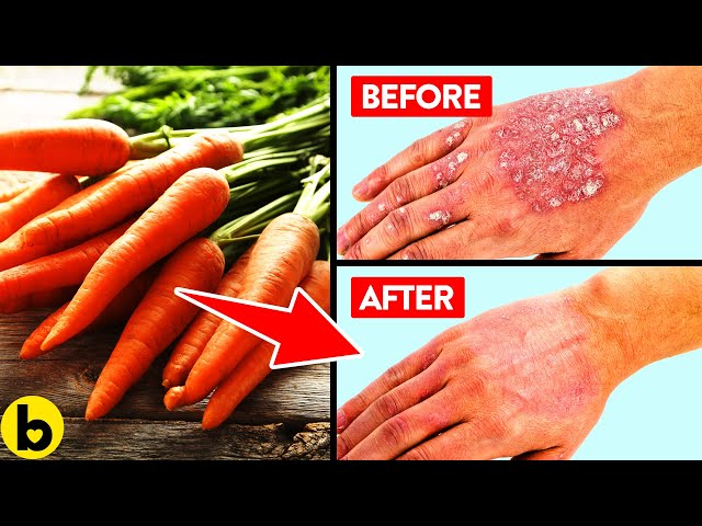 14 Foods That Are Great For Fighting Your Psoriasis