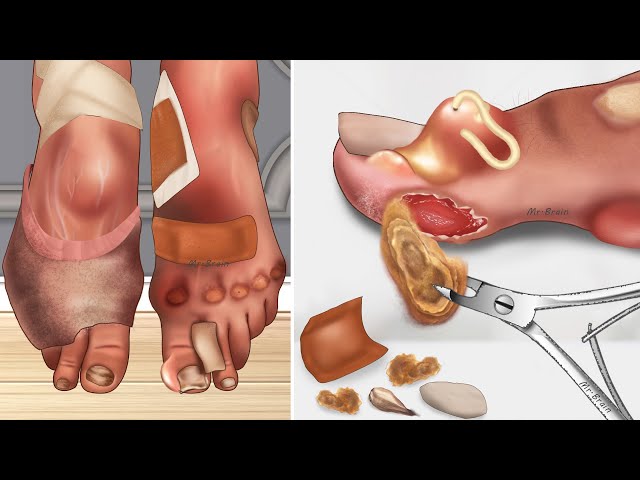 ASMR Swollen corner toenail due to wearing ballet shoes | Nailcare animation