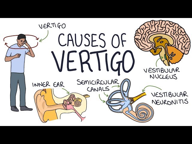 Understanding the Causes of Vertigo