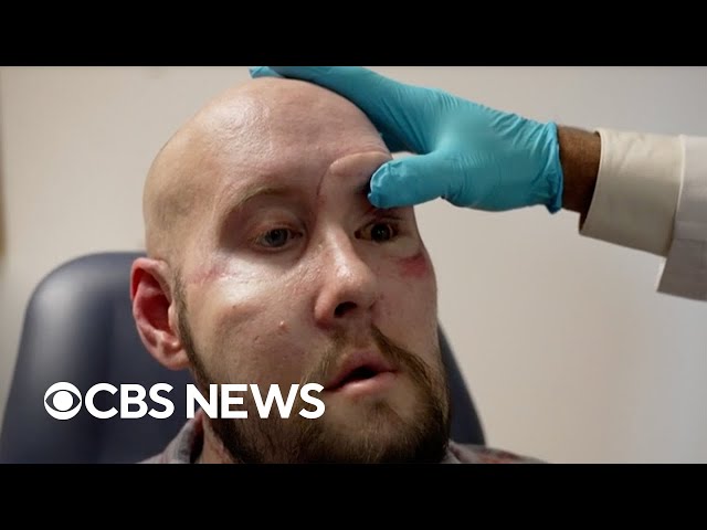 Successful eye transplant, and the healing power of breathing | Eye on America