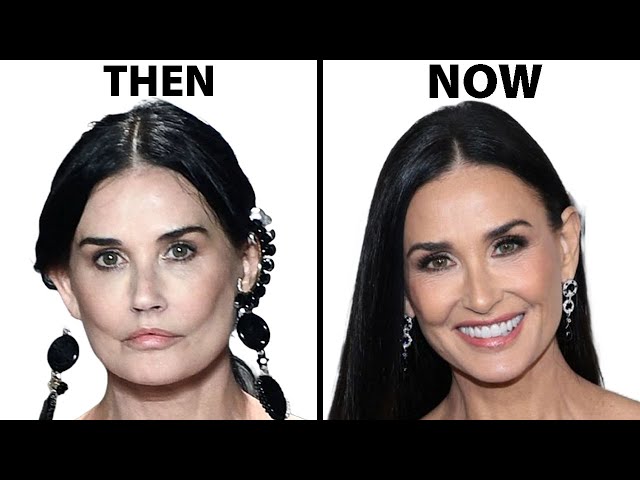 Demi Moore's NEW FACE | Plastic Surgery Analysis