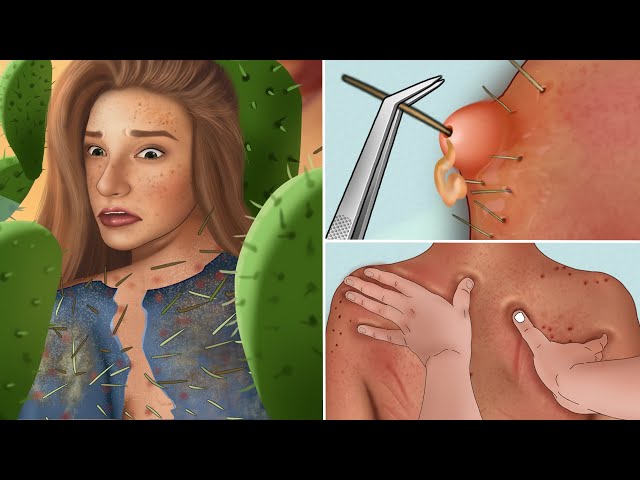 ASMR Treatment pustules caused by cactus thorns animation | Traditional Mexico massage