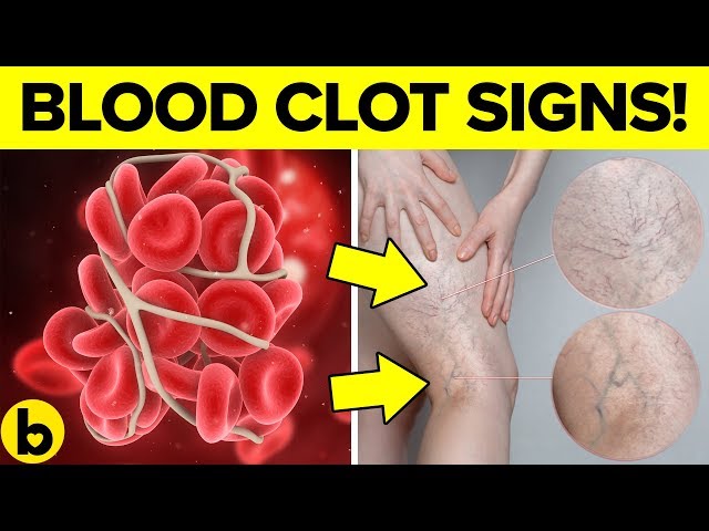 DON'T IGNORE The Warning Signs Of A Blood Clot - You're At Risk!