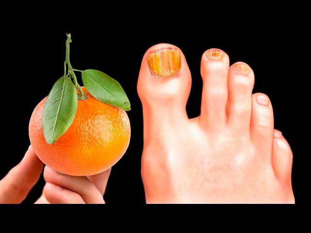 The best remedy for toenail fungus! Get rid of nail fungus immediately! Benefits of Mandarin