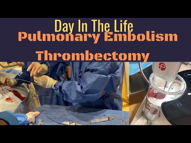 Interventional Radiology - Day in the Life - Episode 2 - PE Thrombectomy