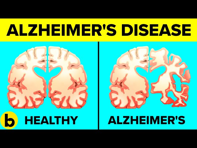 9 Daily Habits That Are Linked To Alzheimer's Disease