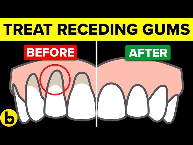How To Treat Your Receding Gums At Home Naturally