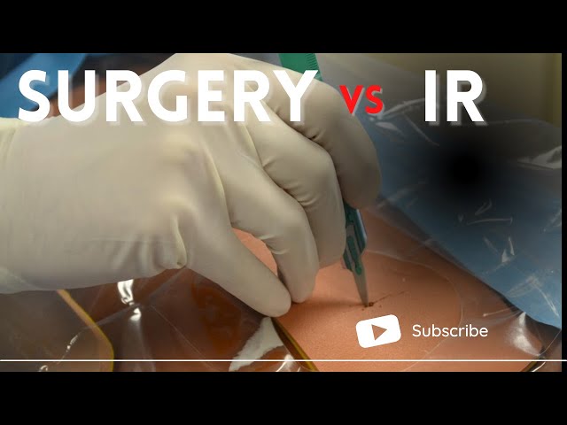 General Surgery vs Interventional Radiology