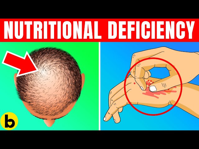 14 Signs That Indicate You Have A Nutritional Deficiency