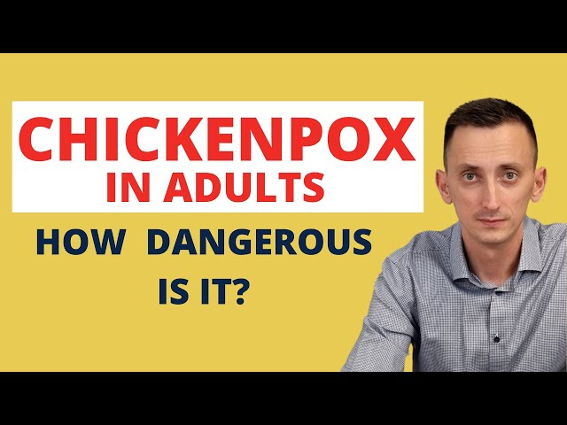 Chickenpox in Adults