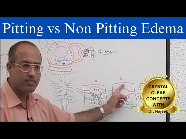 Edema | Pitting  vs Non Pitting Edema