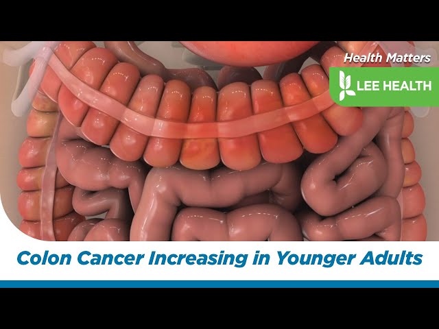 Colon Cancer Increasing in Younger Adults