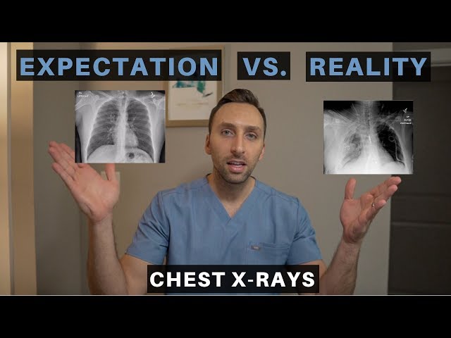 EXPECTATION vs REALITY in RADIOLOGY - How to read a Complicated Chest X-Ray