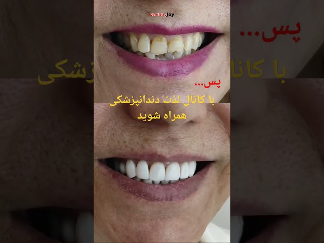 کامپوزیت ونیر و اصلاح لبخند با استفاده از تکنیک های زیبایی دندانها و لبخند