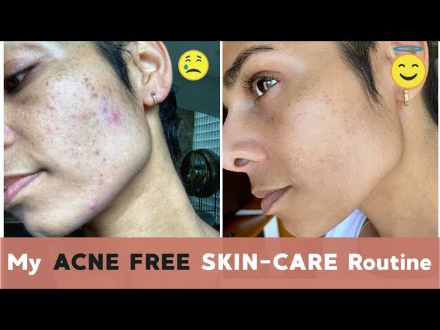 How I Got RID OF ACNE With Lifestyle Changes and CBD