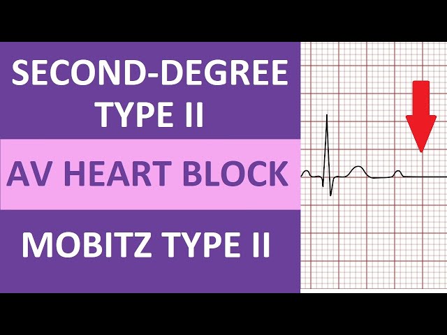 Second-Degree Type 2 Heart Block ECG Rhythm Nursing NCLEX | Mobitz Type II