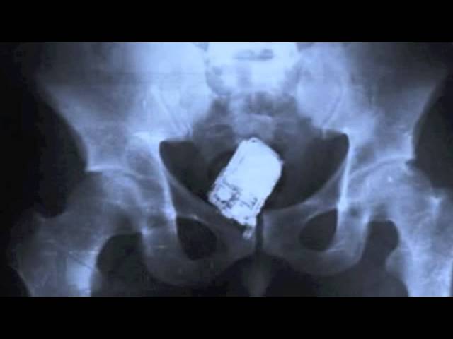25 Strangest Things Found In An X-Ray