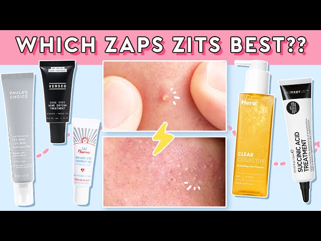 How to Take Care of Your Breakouts, Blackheads & Whiteheads! (2021)
