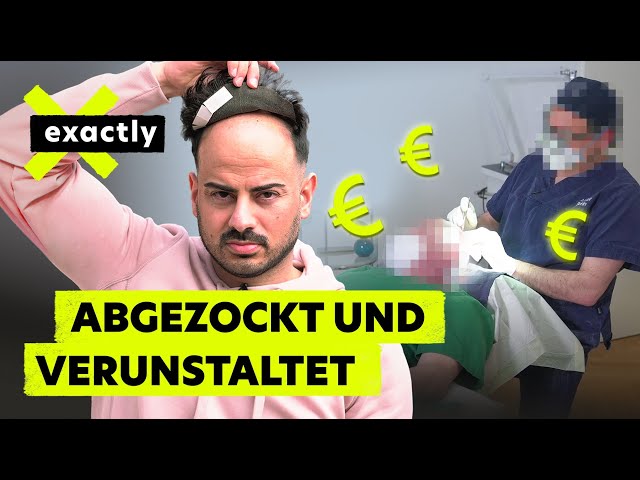 Pfusch und Betrug: Das Geschäft mit dem Haarausfall | Doku | exactly